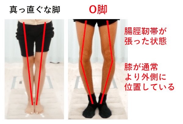 O脚と腸脛靭帯炎の関係