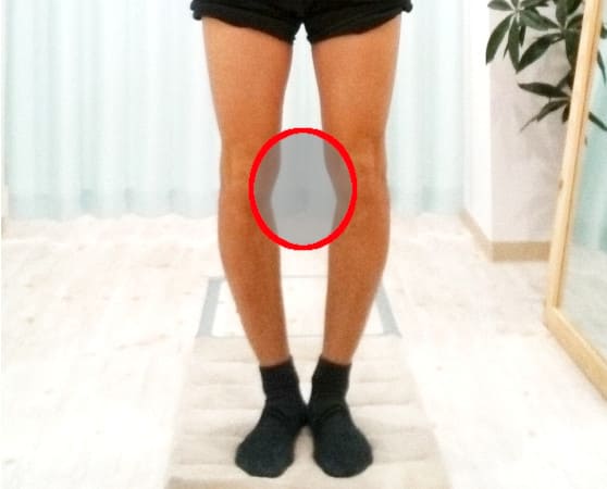 膝の内側痛
