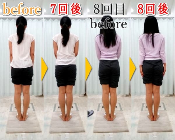 膝下o脚 Xo脚 改善例4 大阪のo脚矯正 整体院 そるん