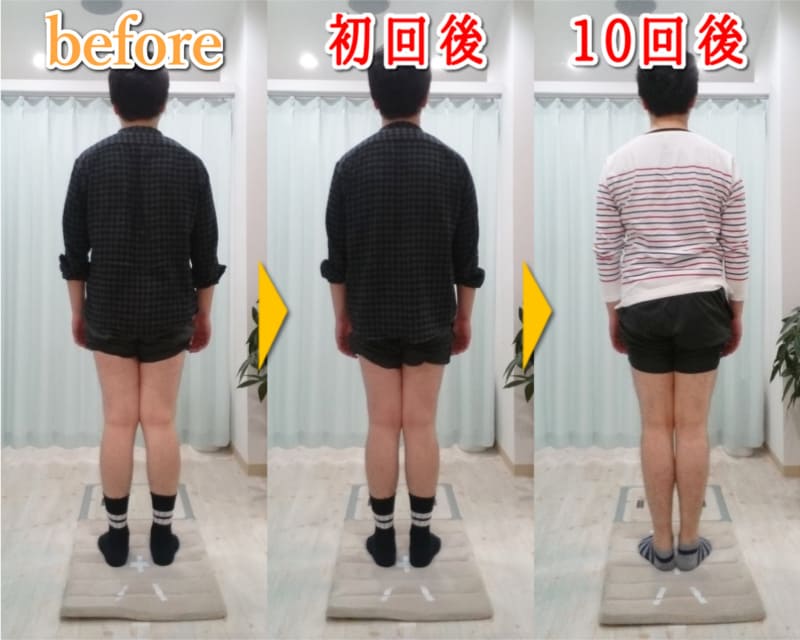 X脚矯正ビフォーアフター男性