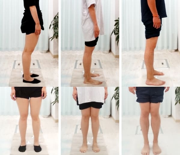 X脚 膝伸展パターン（反張膝）